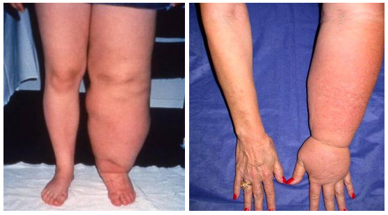 lymphedema